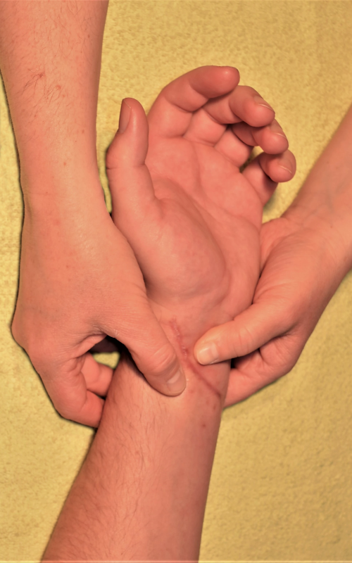 Narbenbehandlung Ergotherapie